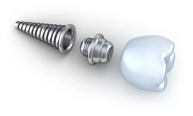 implante dental