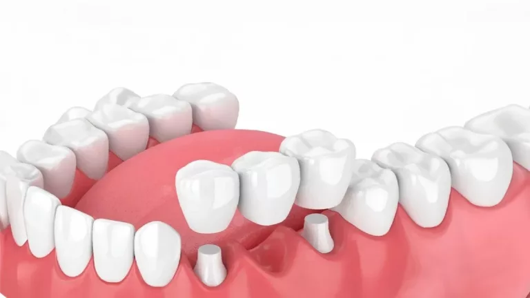 puente fijo dental